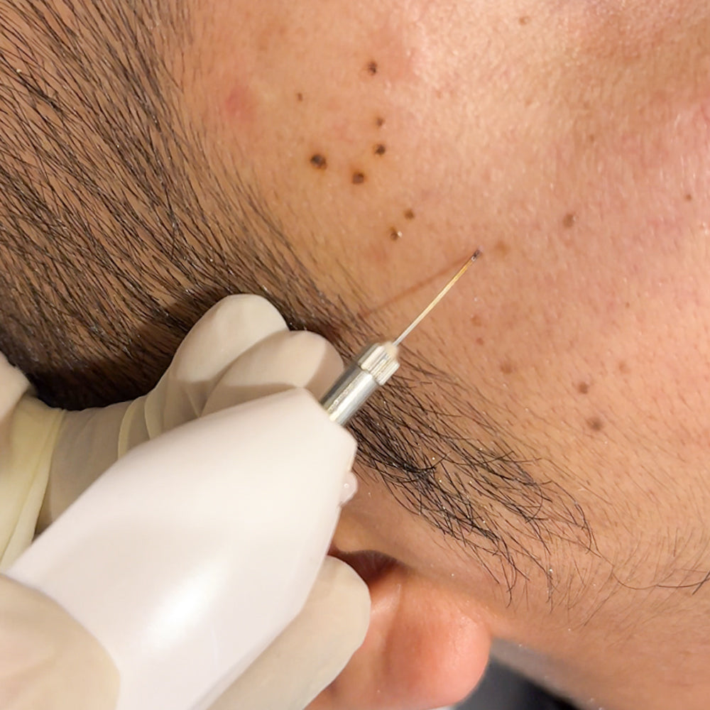 WART REMOVAL