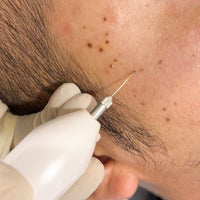 WART REMOVAL